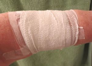 A selfie of my bandaged arm. 